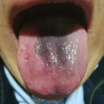 舌苔发黑是什么原因?,舌苔发黑的原因概述